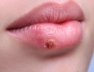 Έρπης: Γιατί είναι συχνότερος το καλοκαίρι – Τι συμβαίνει με την ακτινοβολία του ήλιου